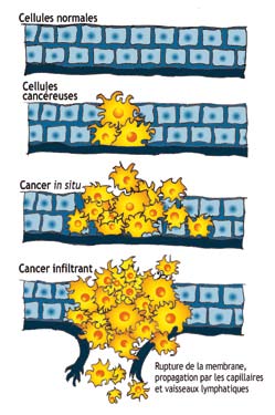 COMPRENDRE LA CHIMIOTHÉRAPIE Qu est ce qu un cancer? Un cancer est une maladie de la cellule*. La cellule est l unité de base de la vie. Il en existe dans le corps plus de deux cents types différents.