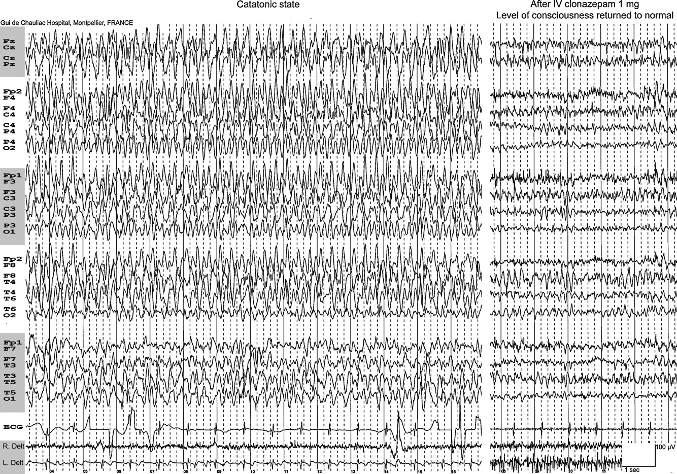 86 P. Thomas, P. Gelisse Figure 2 Patiente présentant une épilepsie myoclonique juvénile et un trouble bipolaire.