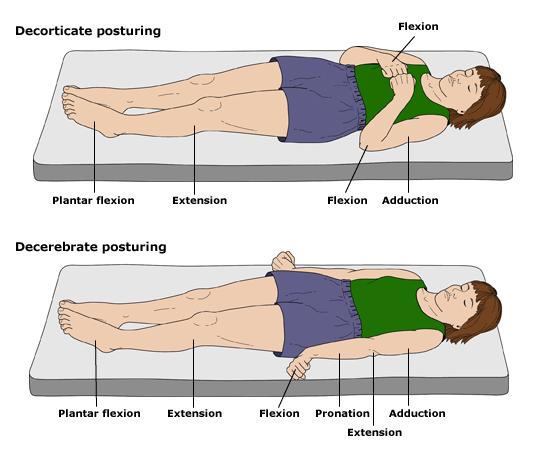 o Réflexes posturaux: Décortication: Lésion aux faisceaux corticospinaux au niveau du
