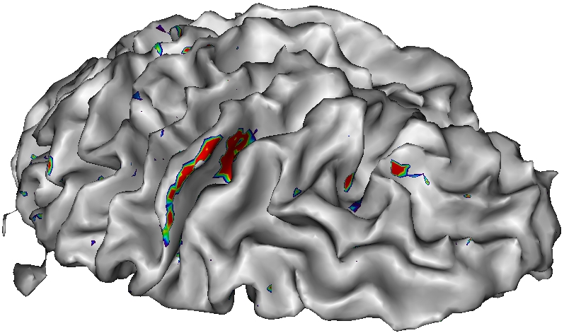 III.5 Thème 4 Reconstruction régularisée en IRM parallèle 55 Fig. III.16 À gauche, parcellisation anatomique du ruban cortical, où chaque hémisphère est parcellisé séparament.