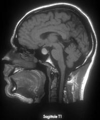 Etiologies des céphalées en coup de tonnerre pouvant être associées à un TDM et PL normaux dissection cervicale : céphalée isolée dans 8%, brutale dans 20% thrombose veineuse cérébrale: céphalée dans