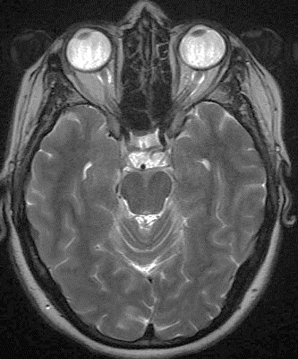 Figure 1: IRM médullaire coupe sagittale, séquence T2, hypersignal médullaire étendu sur 5