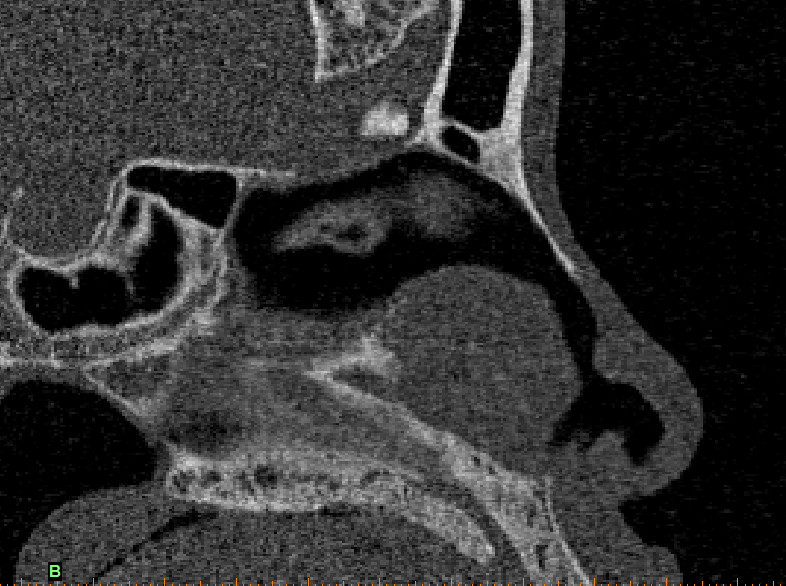 Lame criblée Paroi antérieure du sinus sphénoïdal Os frontal Os propre Figure 2 : Rapports radio-anatomiques de la partie supérieure et postérieure de la fente olfactive Le mur latéral de l ethmoïde