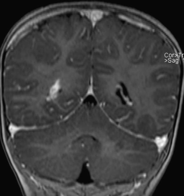 sagittal FLAIR gado 18 mois IRM:SW coronal T1 gado Hypertrophie modérée et rehaussement intense du plexus choroïde D Veine de drainage linéaire péri-ventriculaire