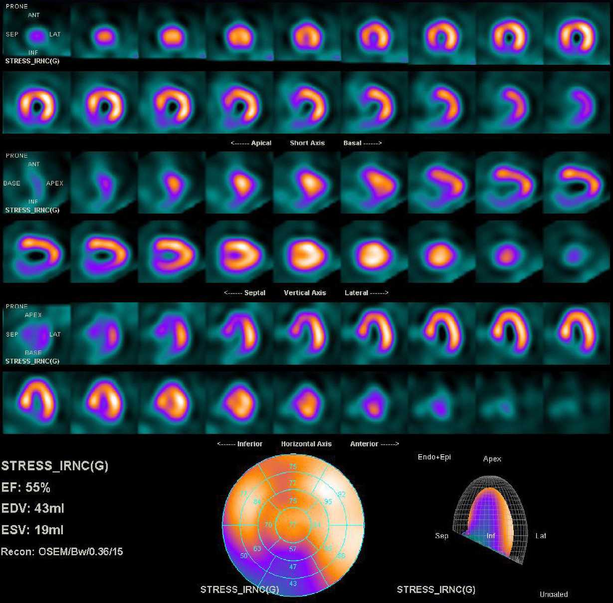 Image obtenue en six minutes avec 74 MBq de thallium 201 chez un homme de 1 m 75 et 70 kg. Normal scan.