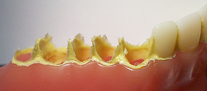 Matériel opératoire - modèle d arcade frasaco bas en résine dure échelle 1/1, 14 dents (dents de sagesse absentes) - silicone par addition fluide basse viscosité à prise lente (Référence Imprint II