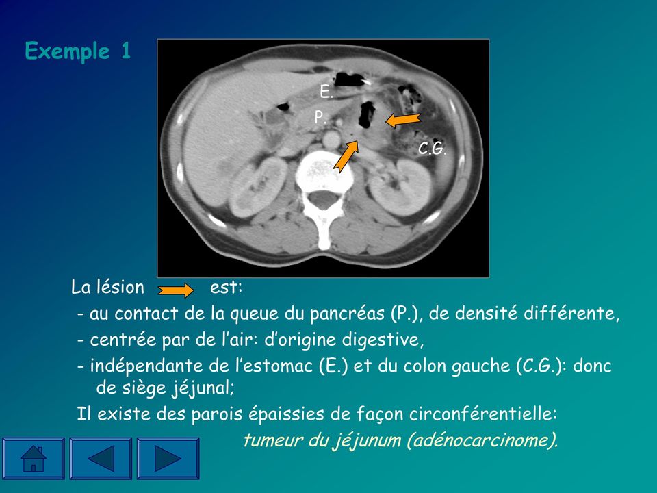 indépendante de l estomac (E.) et du colon gauche (C.G.