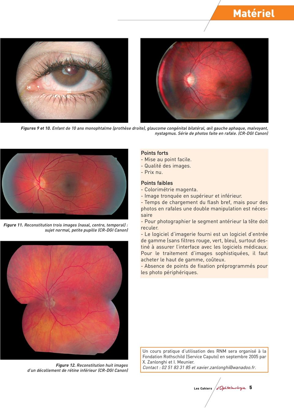 Reconstitution trois images (nasal, centre, temporal) : sujet normal, petite pupille (CR-DGI Canon) Figure 12.
