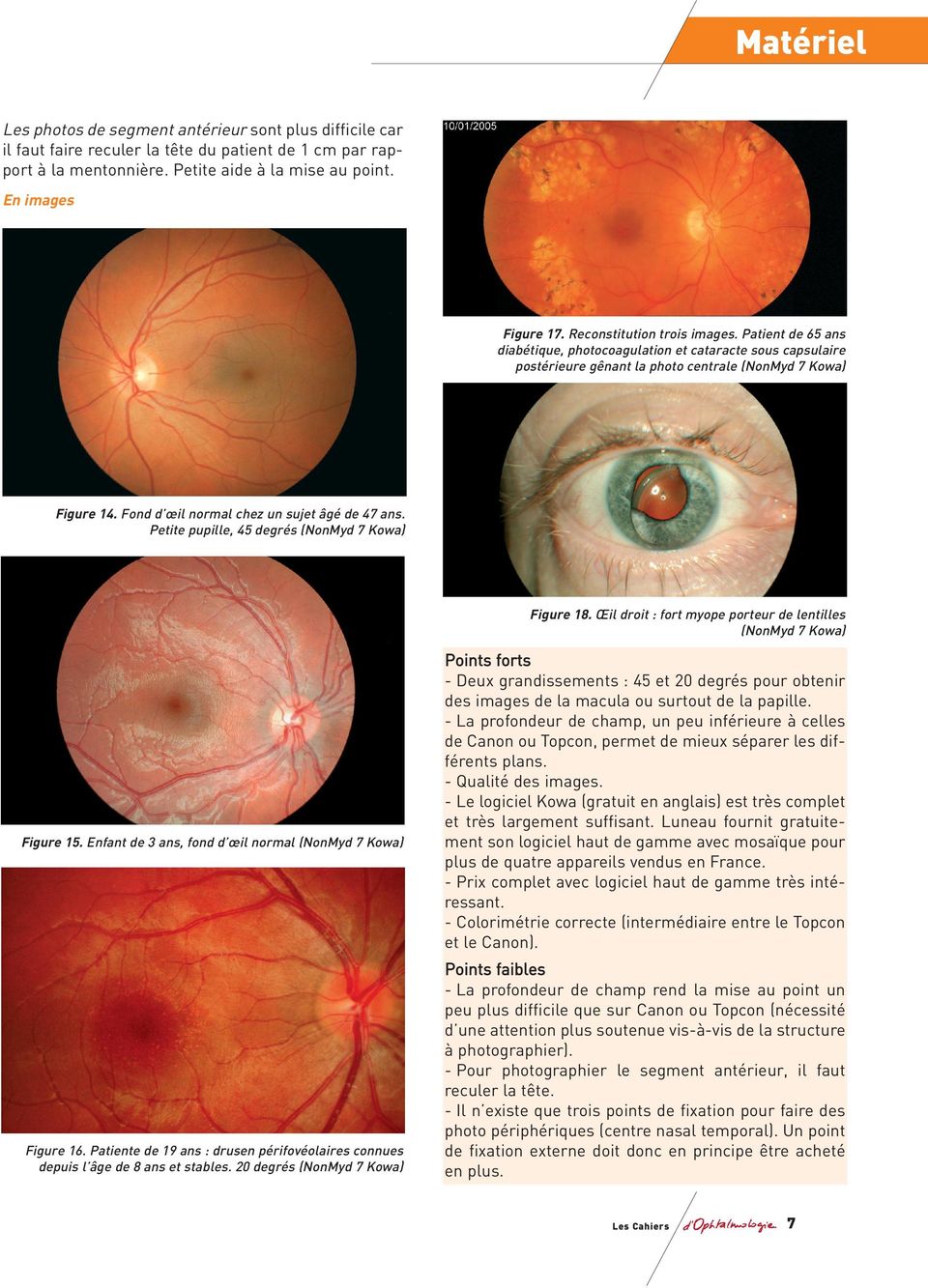 Fond d œil normal chez un sujet âgé de 47 ans. Petite pupille, 45 degrés (NonMyd 7 Kowa) Figure 18. Œil droit : fort myope porteur de lentilles (NonMyd 7 Kowa) Figure 15.