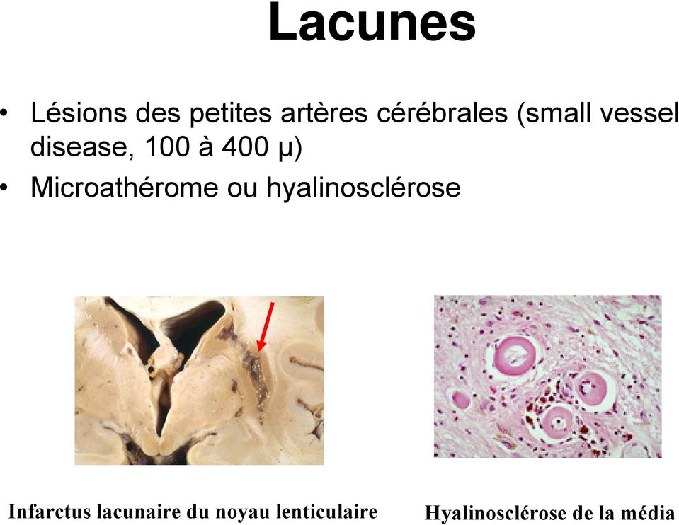 Microathérome ou hyalinosclérose Infarctus