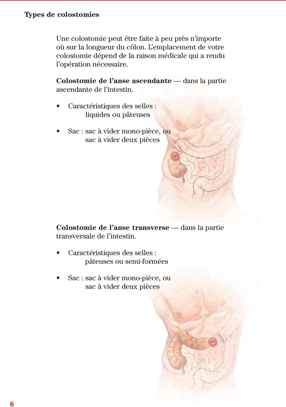 Colostomie de l anse ascendante dans la partie ascendante de l intestin.