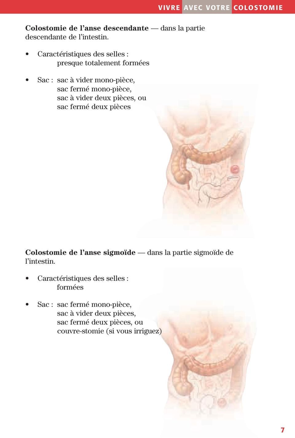 deux pièces, ou sac fermé deux pièces Colostomie de l anse sigmoïde dans la partie sigmoïde de l intestin.