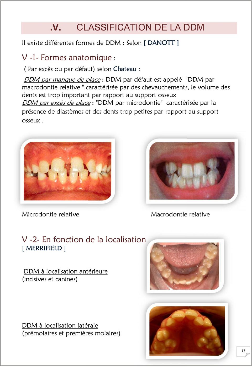 caractérisée par des chevauchements, le volume des dents est trop important par rapport au support osseux DDM par excès de place : "DDM par microdontie" caractérisée par la