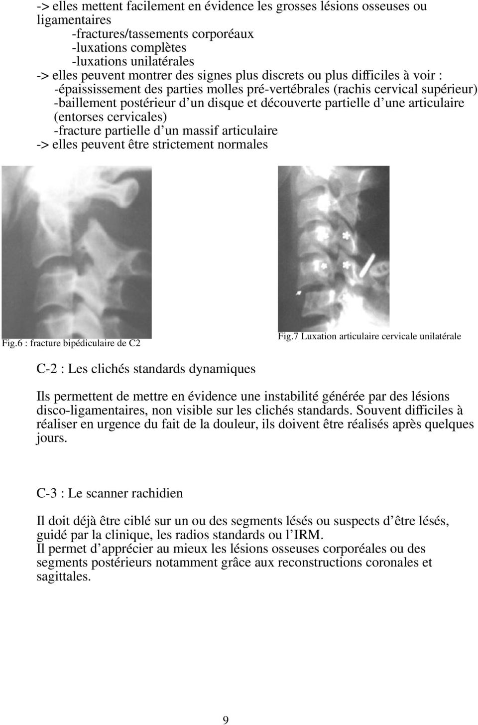 (entorses cervicales) -fracture partielle d un massif articulaire -> elles peuvent être strictement normales Fig.6 : fracture bipédiculaire de C2 Fig.