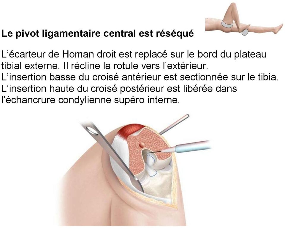 L insertion basse du croisé antérieur est sectionnée sur le tibia.