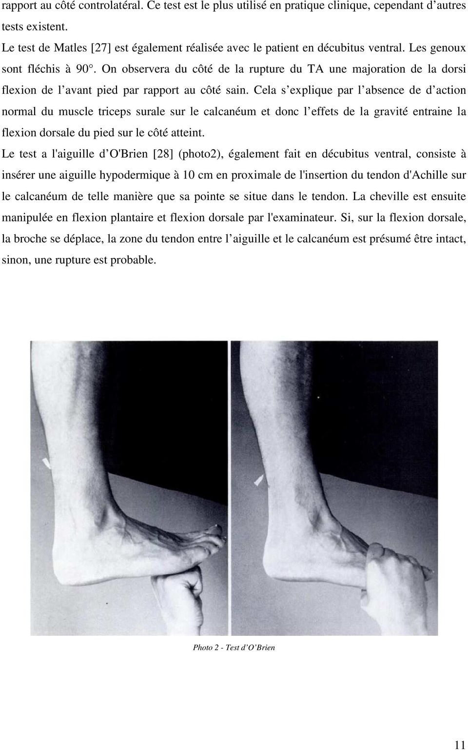 Cela s explique par l absence de d action normal du muscle triceps surale sur le calcanéum et donc l effets de la gravité entraine la flexion dorsale du pied sur le côté atteint.