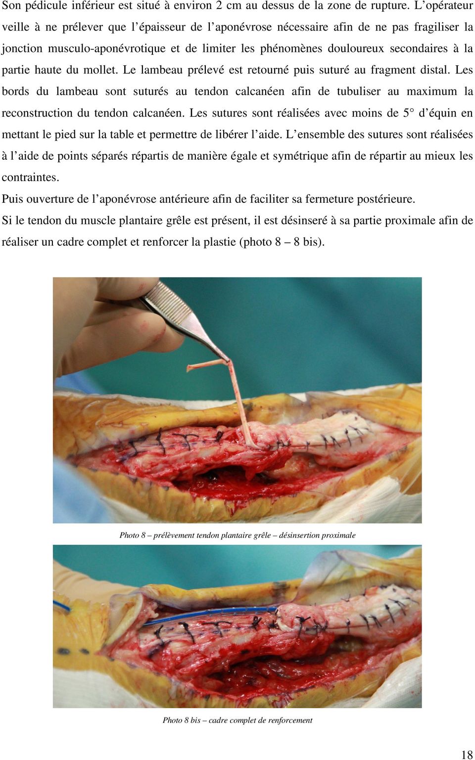 haute du mollet. Le lambeau prélevé est retourné puis suturé au fragment distal.
