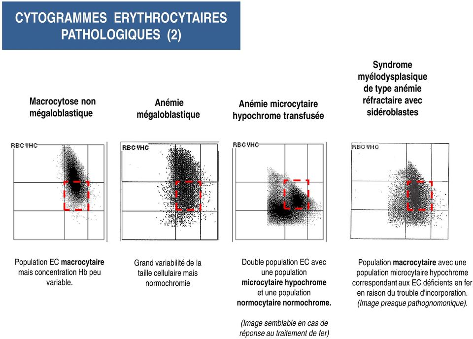 Grand variabilité de la taille cellulaire mais normochromie Double population EC avec une population microcytaire hypochrome et une population normocytaire normochrome.