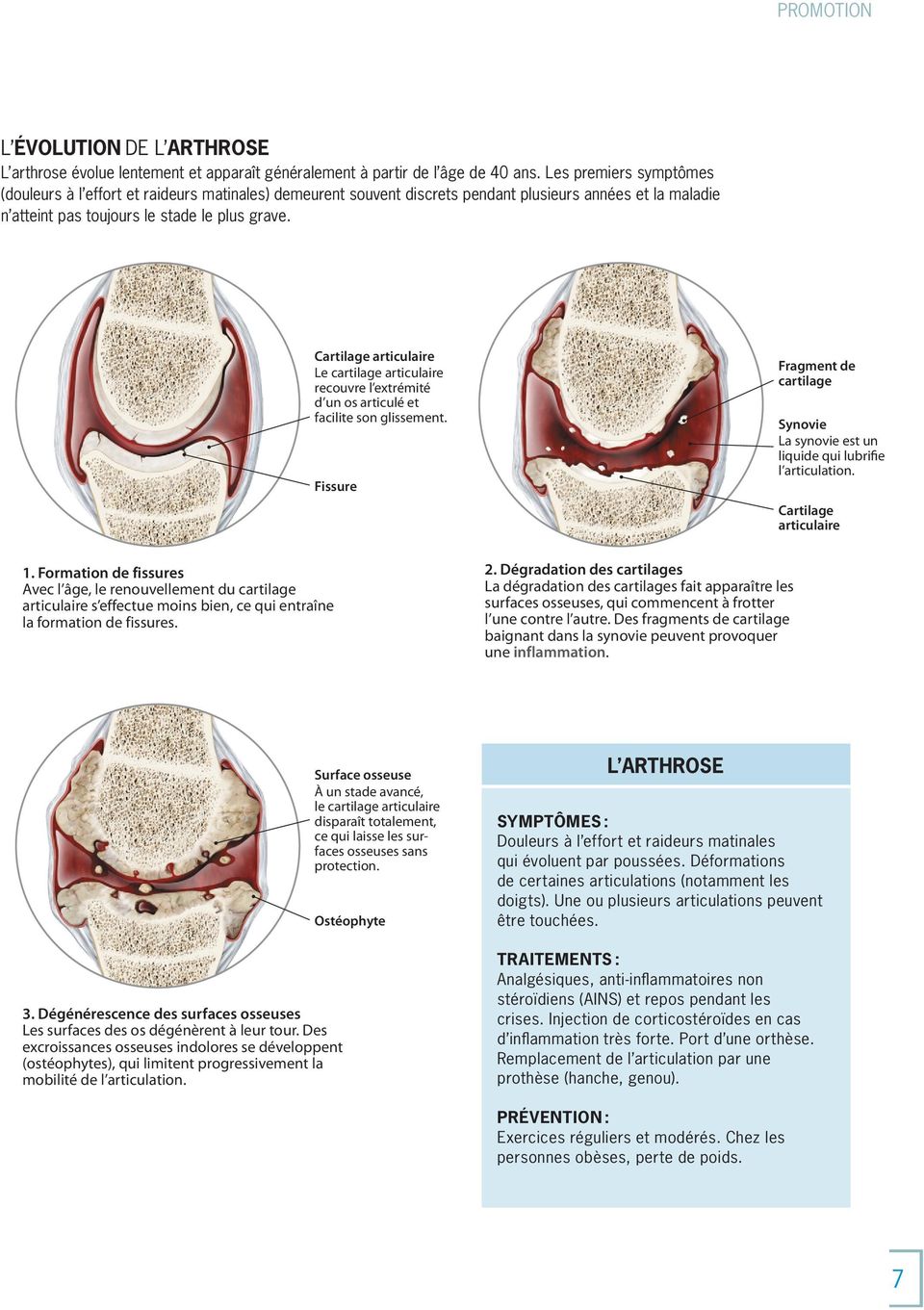 Cartilage articulaire Le cartilage articulaire recouvre l extrémité d un os articulé et facilite son glissement.