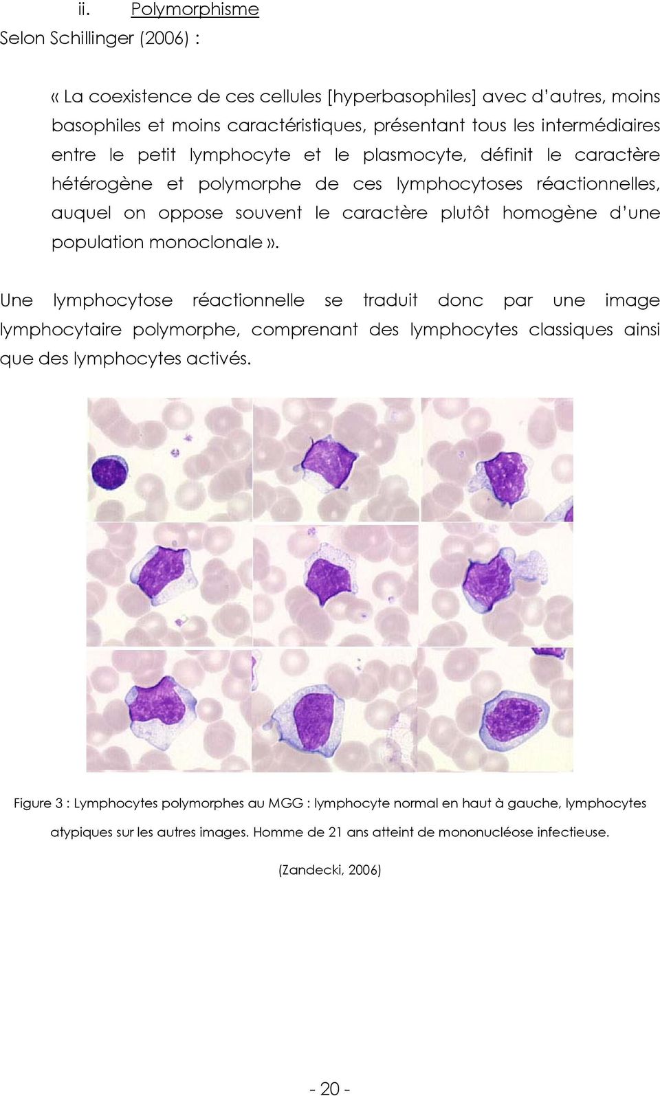 population monoclonale». Une lymphocytose réactionnelle se traduit donc par une image lymphocytaire polymorphe, comprenant des lymphocytes classiques ainsi que des lymphocytes activés.