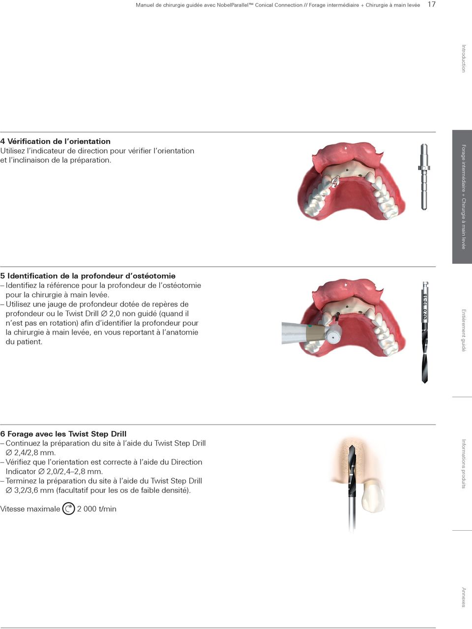 5 Identification de la profondeur d ostéotomie Identifiez la référence pour la profondeur de l ostéotomie pour la chirurgie à main levée.