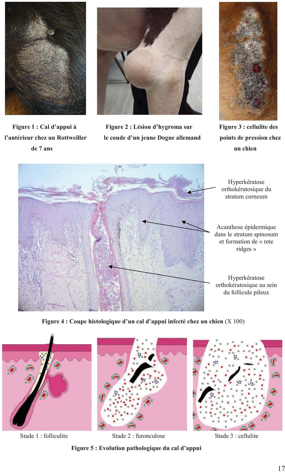 spinosum et formation de «rete ridges» Hyperkératose orthokératosique au sein du follicule pileux Figure 4 : Coupe histologique d un cal d