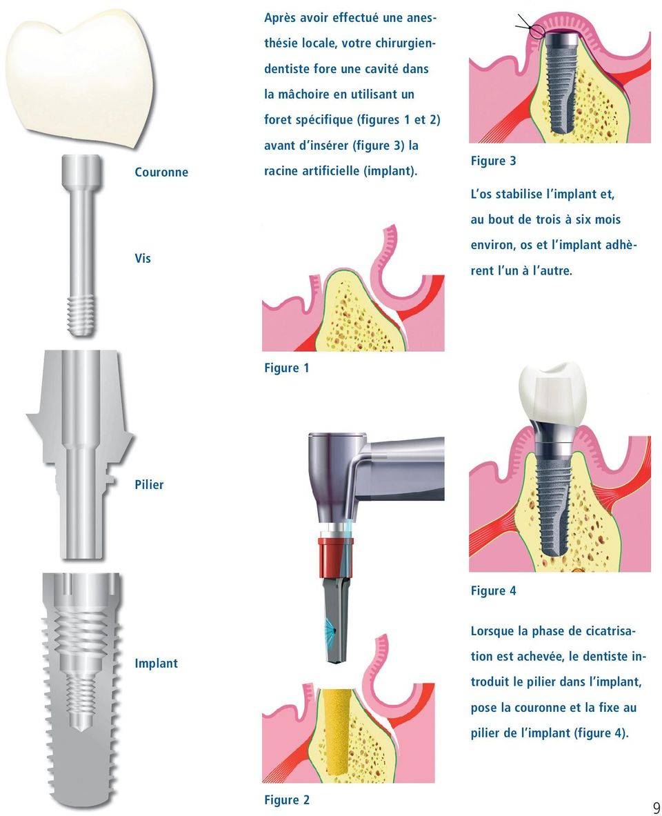 Figure 3 L os stabilise l implant et, au bout de trois à six mois environ, os et l implant adhèrent l un à l autre.