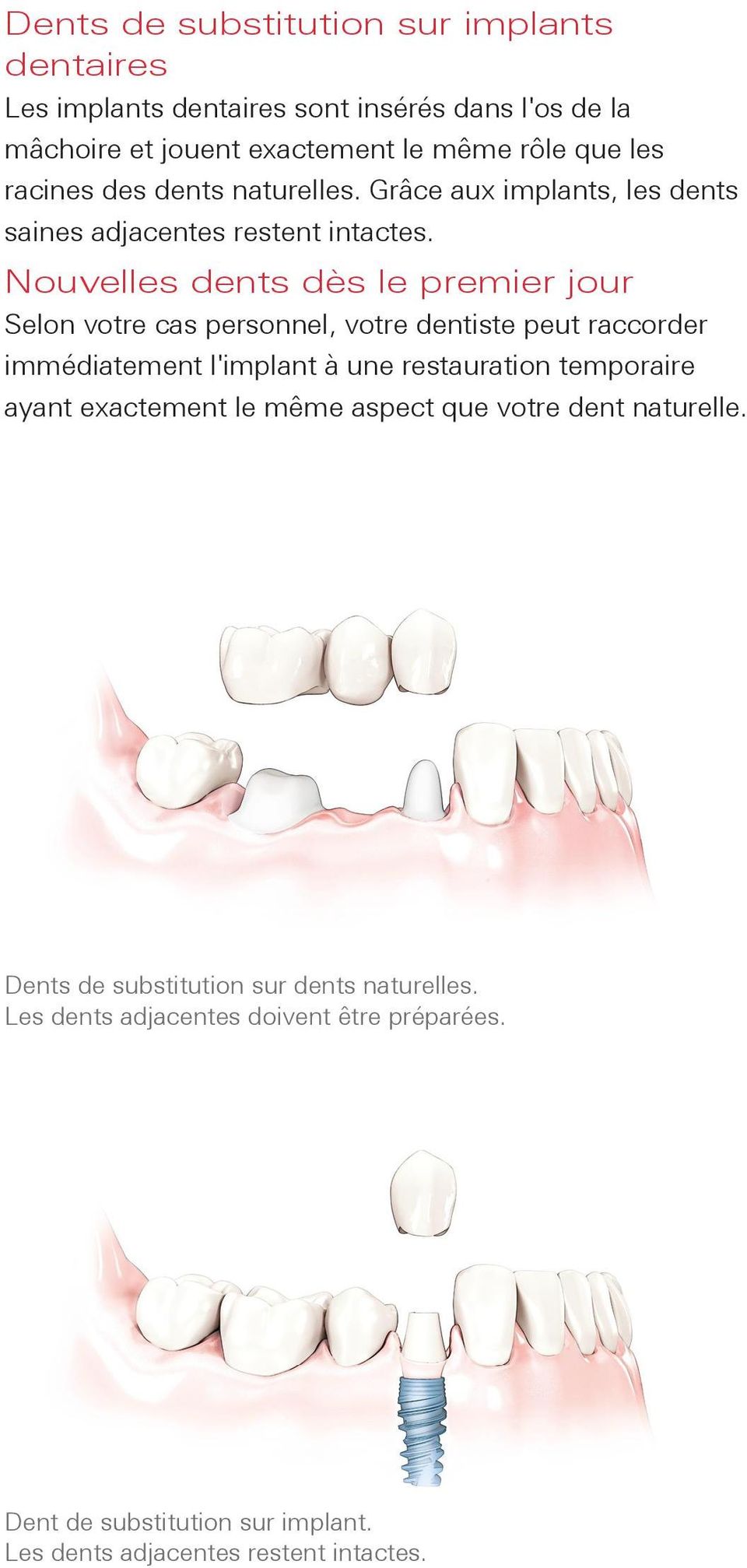 Nouvelles dents dès le premier jour Selon votre cas personnel, votre dentiste peut raccorder immédiatement l'implant à une restauration temporaire ayant