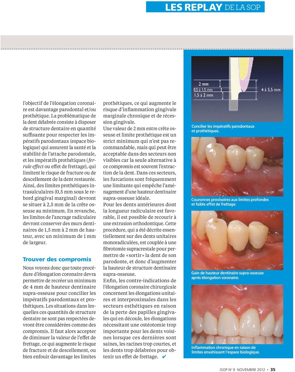 stabilité de l attache parodontale, et les impératifs prothétiques ( ferrule effect ou effet de frettage), qui limitent le risque de fracture ou de descellement de la dent restaurée.