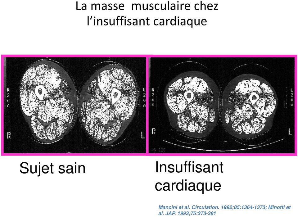 cardiaque Mancini et al. Circulation.