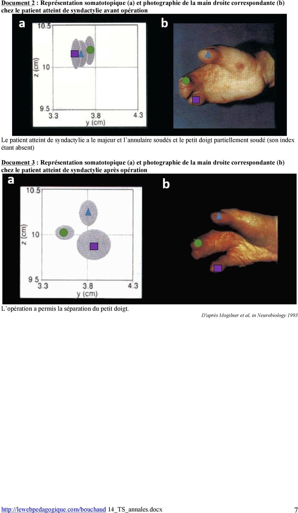 Document 3 : Représentation somatotopique (a) et photographie de la main droite correspondante (b) chez le patient atteint de syndactylie après