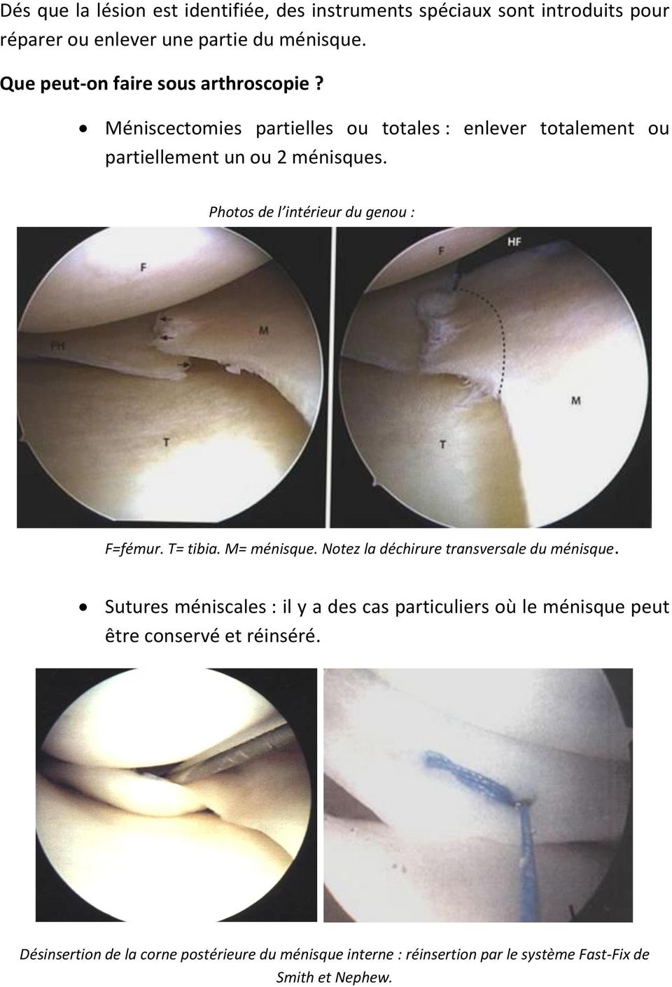 Photos de l intérieur du genou : F=fémur. T= tibia. M= ménisque. Notez la déchirure transversale du ménisque.