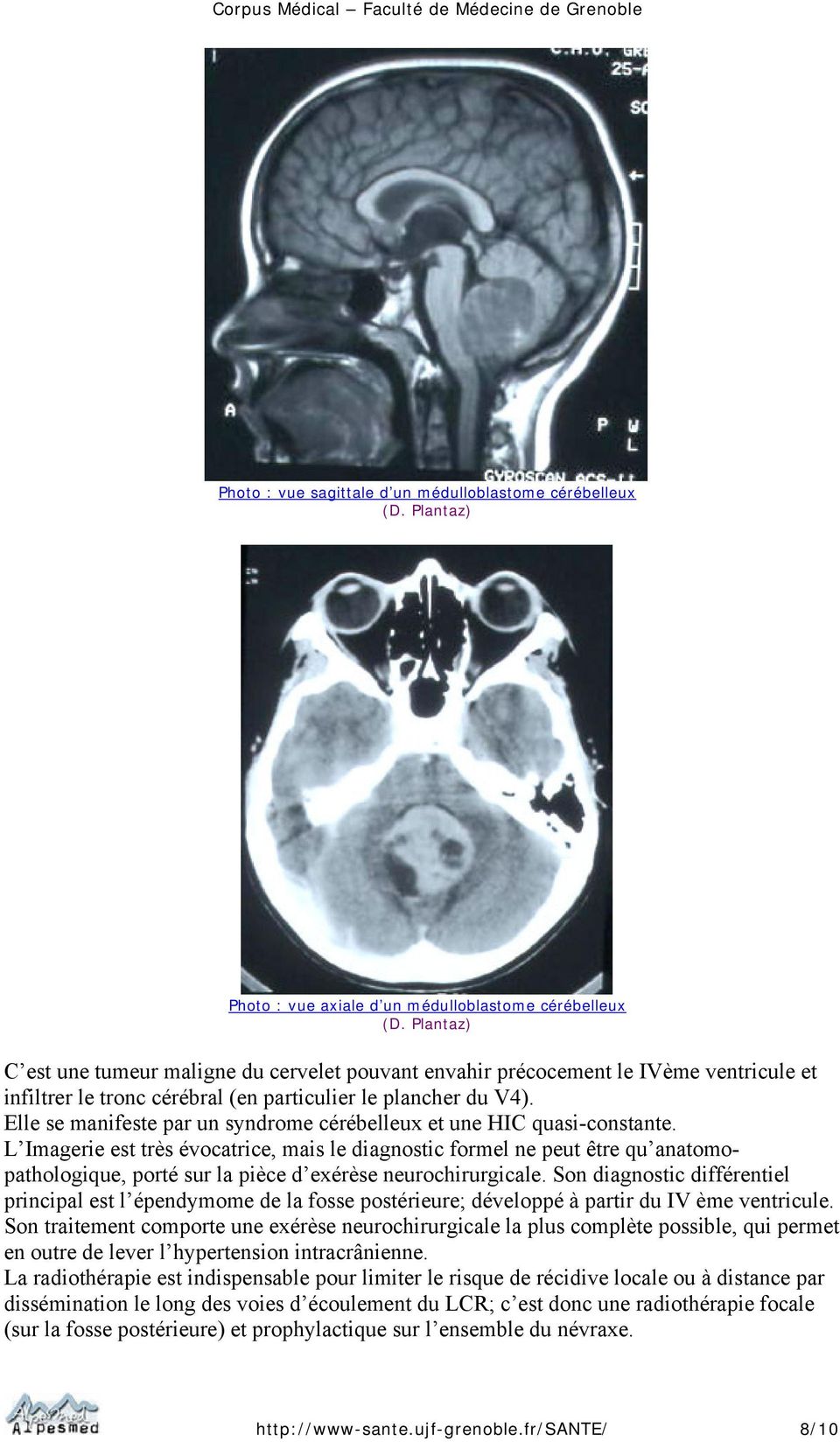 L Imagerie est très évocatrice, mais le diagnostic formel ne peut être qu anatomopathologique, porté sur la pièce d exérèse neurochirurgicale.