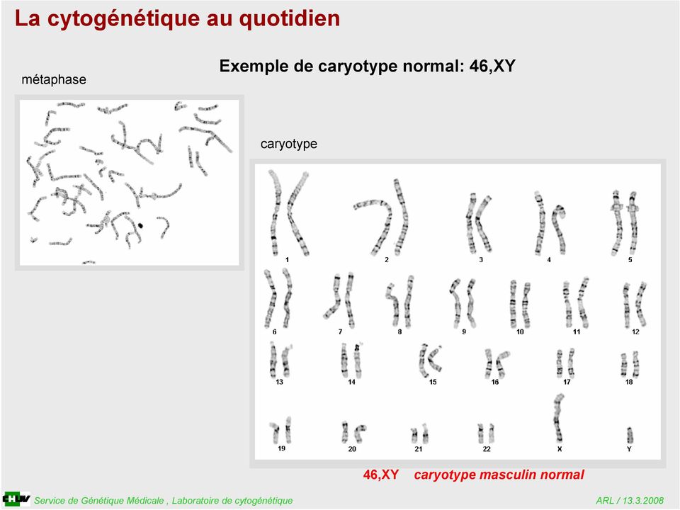 de caryotype normal: 46,XY