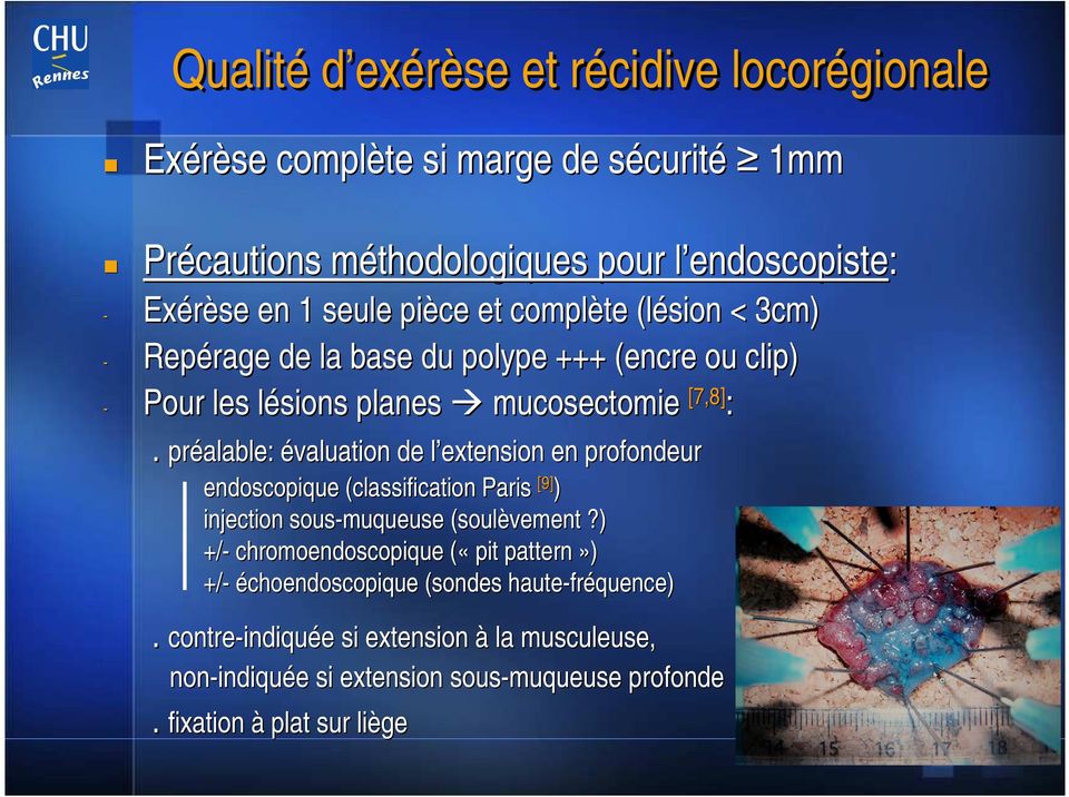 préalable: évaluation de l extension l en profondeur endoscopique (classification Paris [9] ) injection sous-muqueuse (soulèvement?