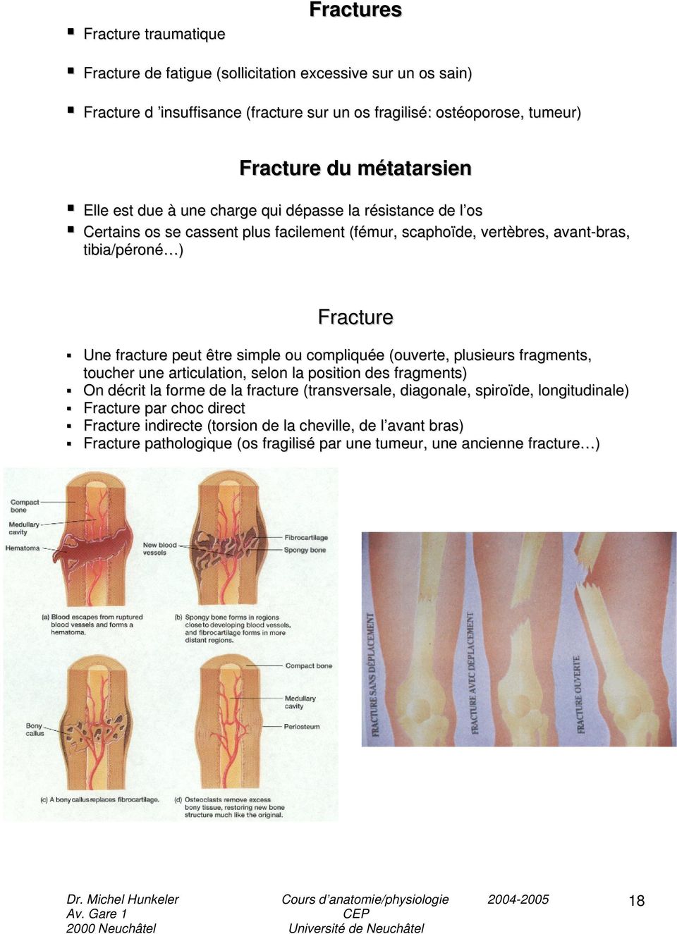fracture peut être simple ou compliquée (ouverte, plusieurs fragments, toucher une articulation, selon la position des fragments) On décrit la forme de la fracture (transversale,
