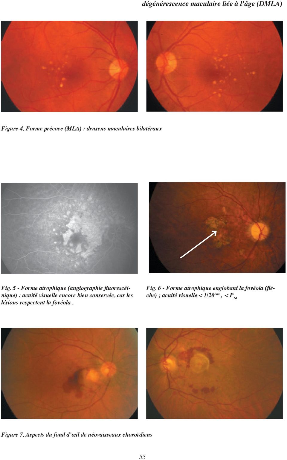 5 - Forme atrophique (angiographie fluorescéinique) : acuité visuelle encore bien conservée, cas