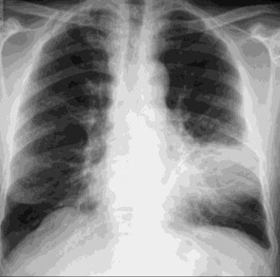 LES LESIONS PARENCHYMATEUSES (n=10) Infarctus pulmonaires sur EP (5 cas) Infiltrats parenchymateux diffus bases pulmonaire (1 cas) Atélectasie de la base pulmonaire Dte (1