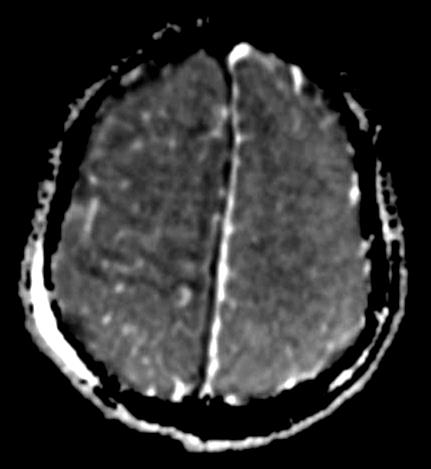 Traitement chirurgical Abcès cérébraux Ponction- aspiration Craniotomie = volet -si arrière-pensée résection