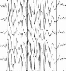 pharmacosensibles signature EEG +++ E métaboliquesstructurelles (symptomatiques) cause retrouvée: Lésion cérébrale structurelle