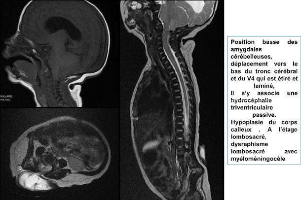Malformation de Chiari type II : petite fosse postérieure associée à un déplacement vers le bas vers le trou occipital et le canal rachidien cervical des amygdales cérébelleuses, du V4, du vermis et