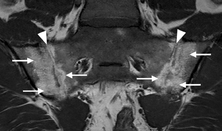 ORTHOPÉDIE PRATIQUE Figure 5 - Ostéose iliaque condensante bilatérale chez une femme de 31 ans, G2P2.