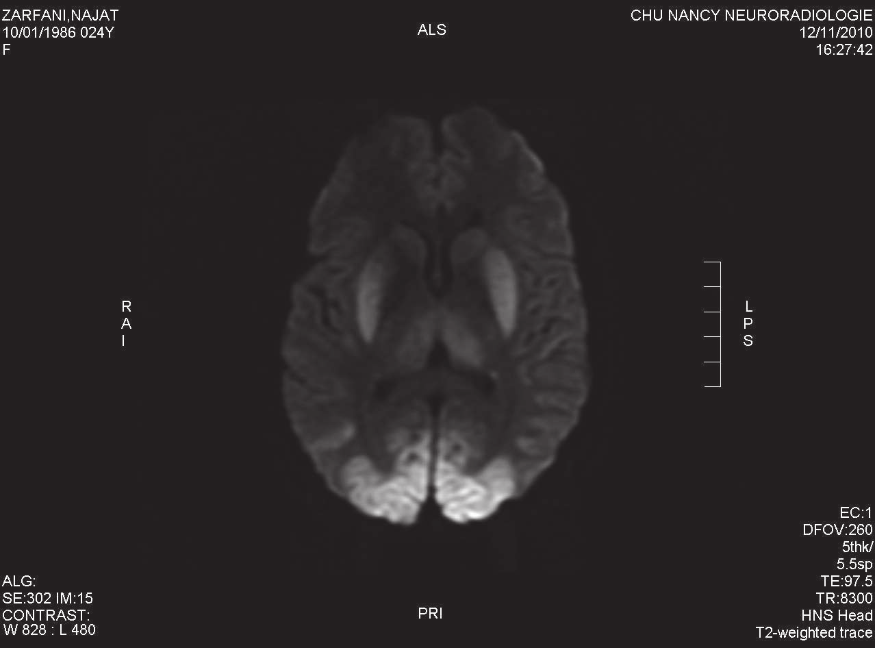 IRM cérébrale à 24h: lésions étendues et symétriques corticales et des