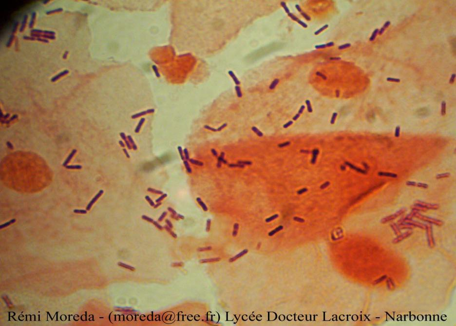 Examen microbiologique Examen microscopique Etat frais: - Cytologie: noter une réaction inflammatoire, desquamation cellules épithéliales - présence de