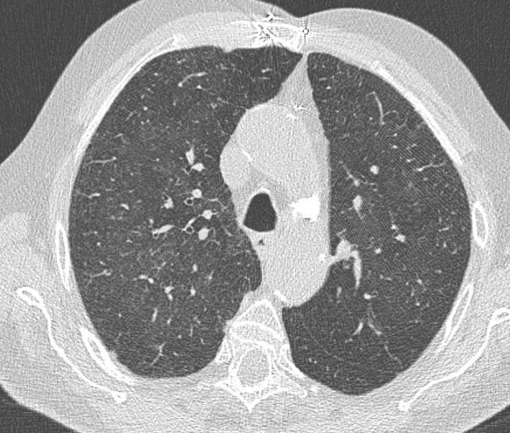 RB-ILD : Bronchiolite respiratoire associée à une pathologie infiltrative diffuse dyspnée Tabagisme majeur RT : poumon