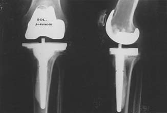 236 Fractures du genou peut être judicieux de mettre en place une prothèse totale du genou.