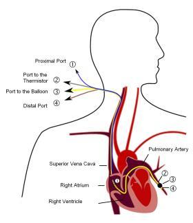 Cathéter de Swan-Ganz : Cas particuliers voie veineuse centrale pour mesures hémodynamiques: Pression artérielle pulmonaire (PAP), Pression