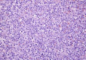Grandes cellules lymphocytaires tumorales à