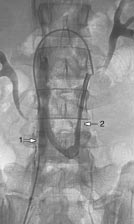 Radiodiagnostic Traitement endovasculaire des varicocèles 34-450-D-10 4 (A, B, C) Variations anatomiques de la veine rénale gauche.