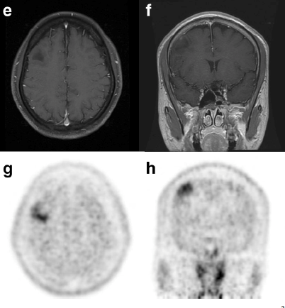 11 C-Methionine Acide aminé neutre le plus étudié en neuro-oncologie Intérêt important du fait d un faible signal de fond cérébral Meilleur sensibilité que le FDG (bas grade ++) Utilitépour guider